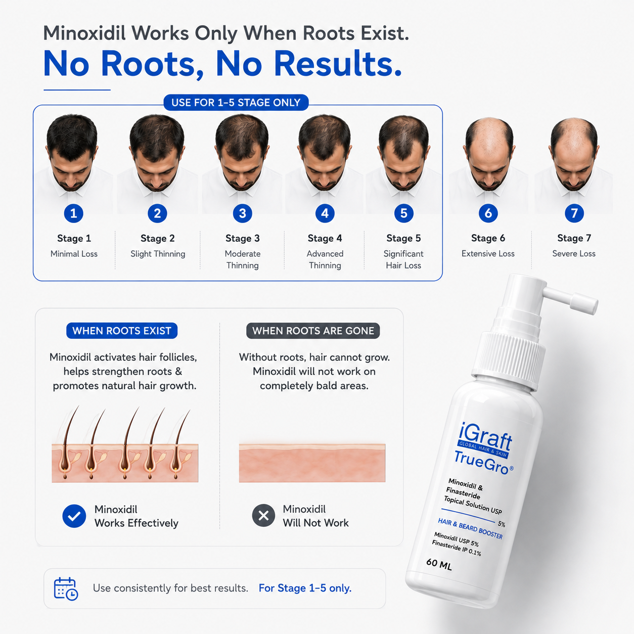 TrueGro™ 5% Minoxidil + 0.1% Finasteride