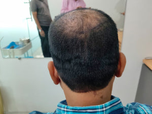 Before - Month 1
