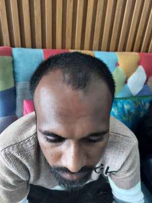 Before - Month 1