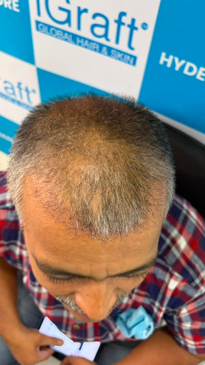 After - Month 5