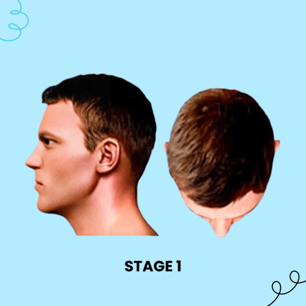 Stage 1 Hair Loss Solution Male