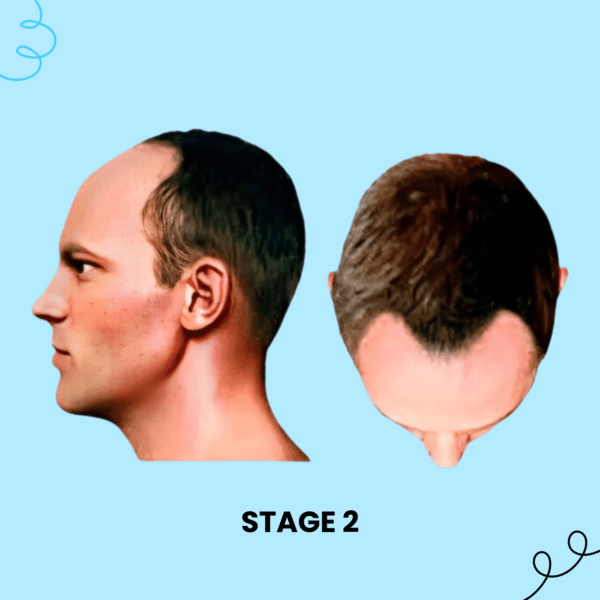 Stage 2 Hair Loss Solution Male