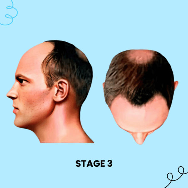 Stage 3 Hair Loss Solution Male