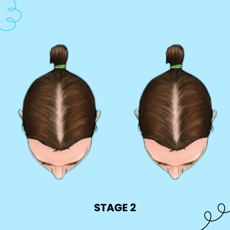 Stage 2 Hair Fall Solution Female