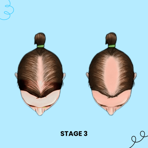 Stage 3 Hair Loss Solution Female