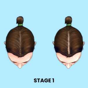 Stage 1 Hair Loss Solution Female