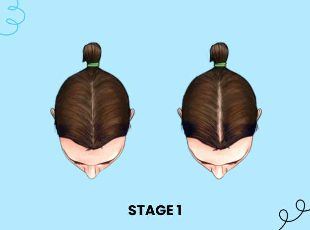 Stage 1 Hair Loss Solution Female