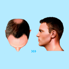 After Hair Transplant