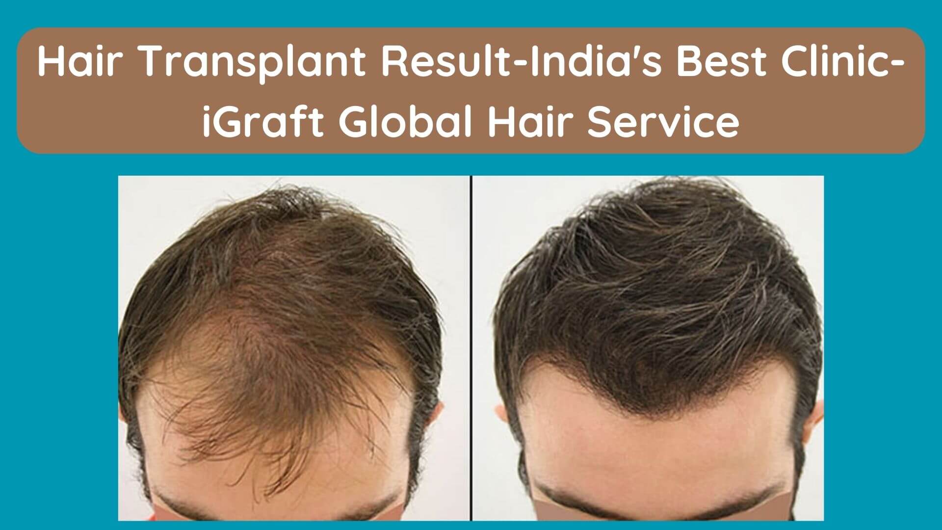 Hair Transplant Result