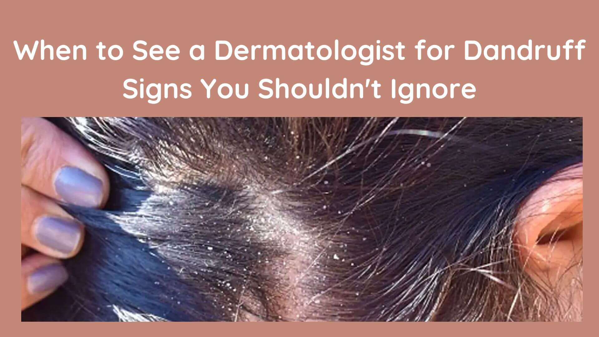 When to See a Dermatologist for Dandruff: Signs You Shouldn't Ignore