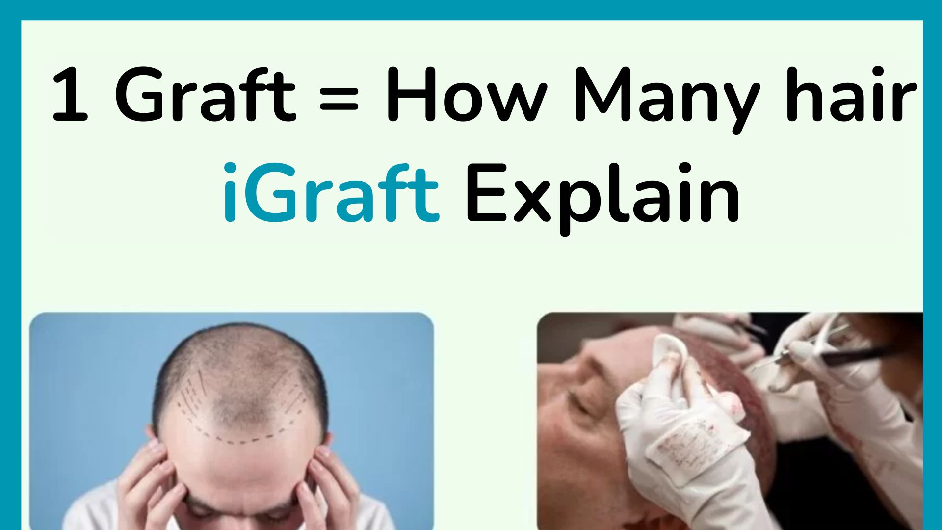 1 graft = how many hair – iGraft Explain