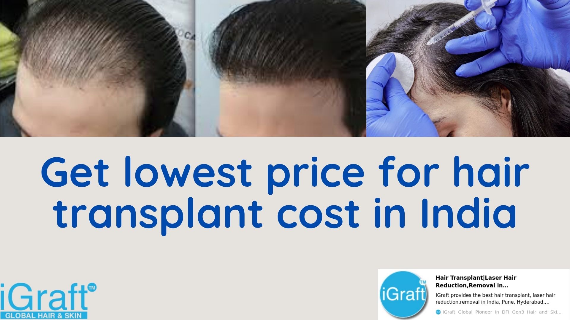 Get lowest price for hair transplant cost in India