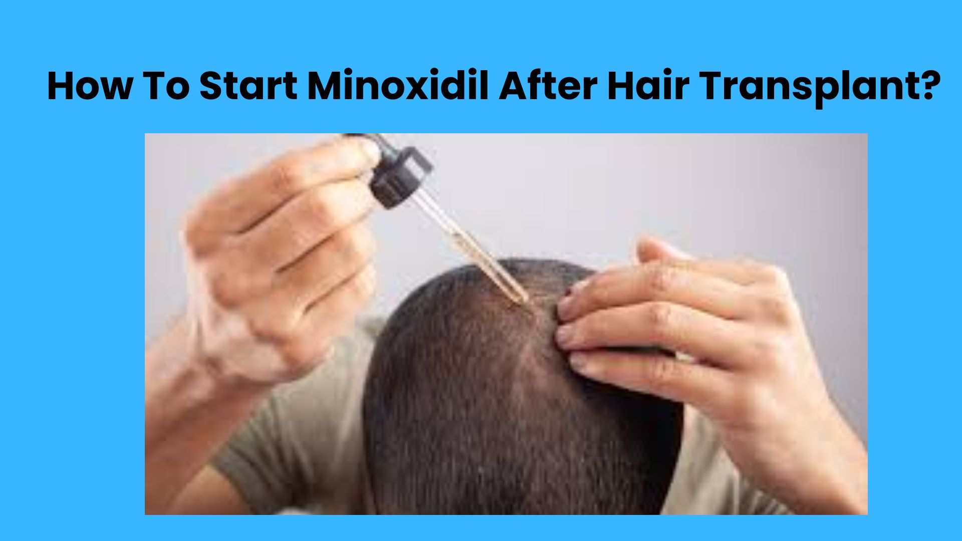How To Start Minoxidil After Hair Transplant?