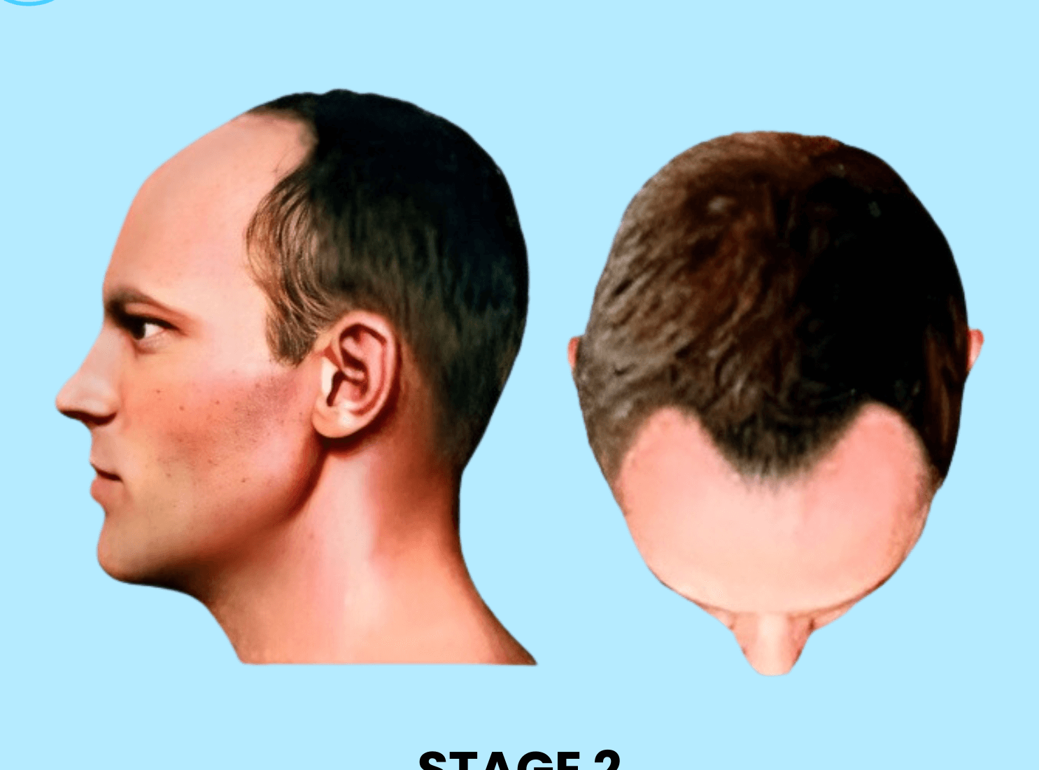 Stage 2 Hair Loss Solution Male